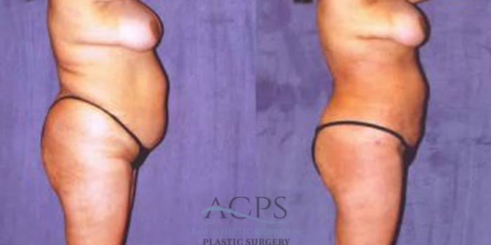 Before & After Liposuction Case 244 Side View: View in Houston, TX