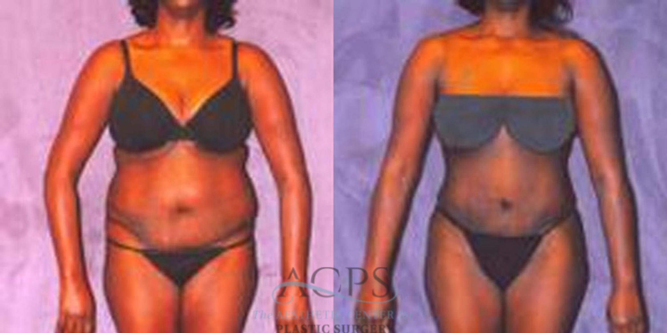 Before & After Liposuction Case 245 Front View: View in Houston, TX