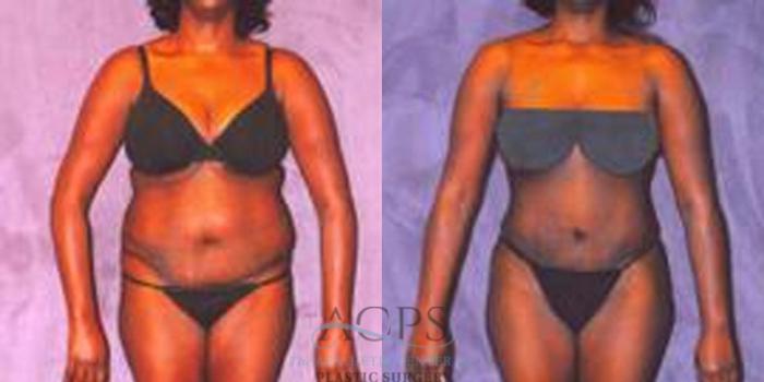 Before & After Liposuction Case 245 Front View: View in Houston, TX