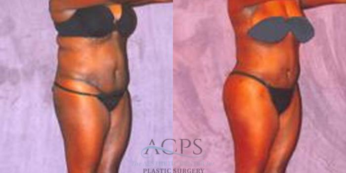 Before & After Liposuction Case 245 Oblique View: View in Houston, TX