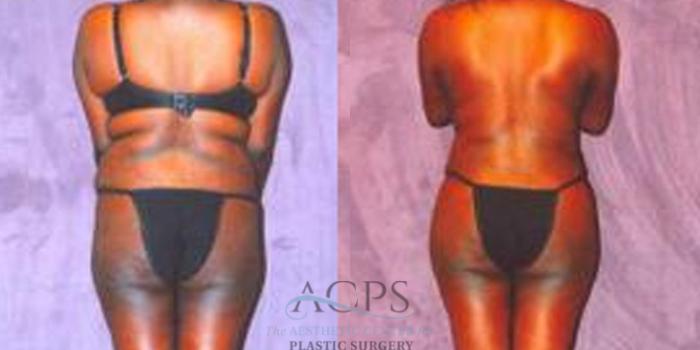 Before & After Liposuction Case 245 Rear View: View in Houston, TX