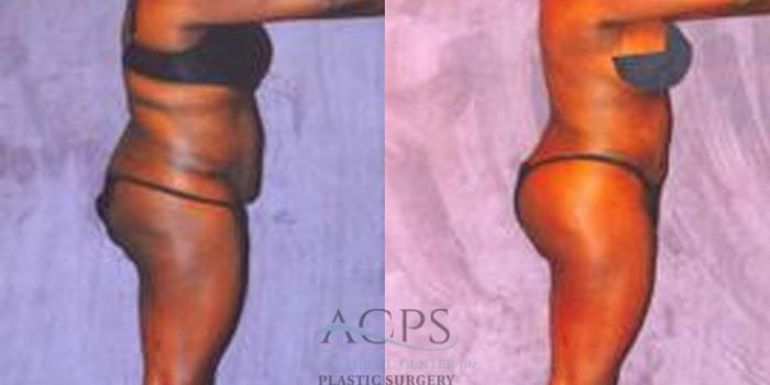 Before & After Liposuction Case 245 Side View: View in Houston, TX
