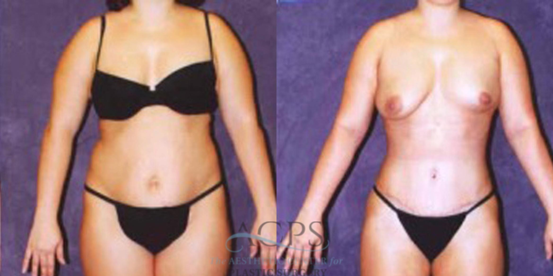 Before & After Liposuction Case 246 Front View: View in Houston, TX