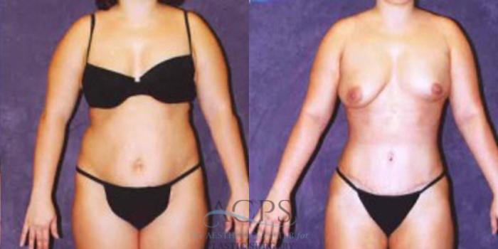 Before & After Liposuction Case 246 Front View: View in Houston, TX