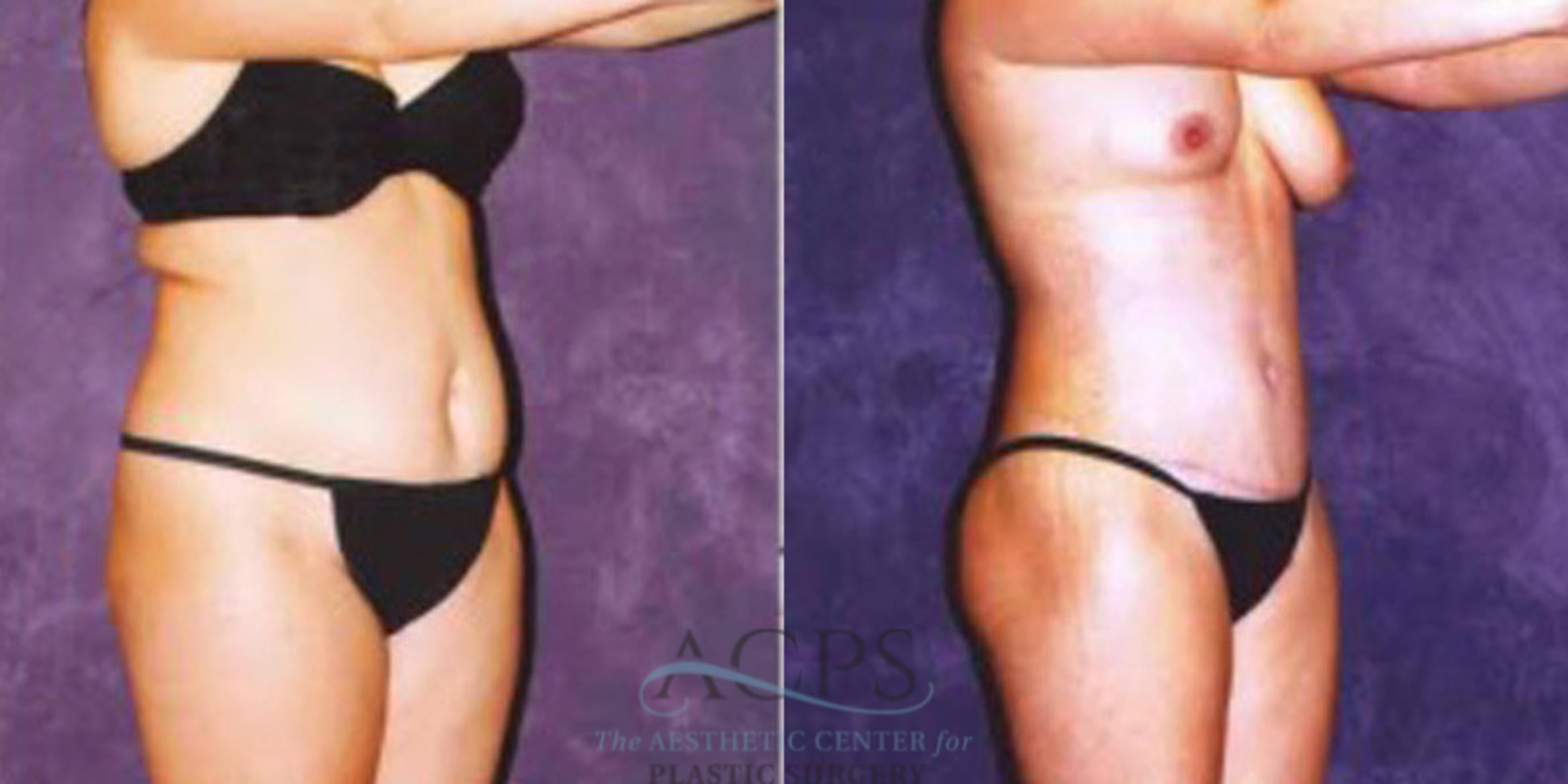 Before & After Liposuction Case 246 Oblique View: View in Houston, TX