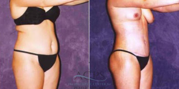 Before & After Liposuction Case 246 Oblique View: View in Houston, TX