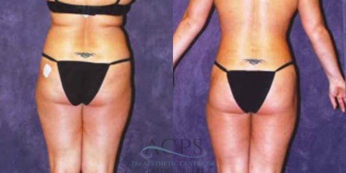 Before & After Liposuction Case 246 Rear View: View in Houston, TX