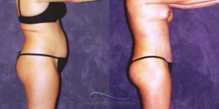 Before & After Liposuction Case 246 Side View: View in Houston, TX