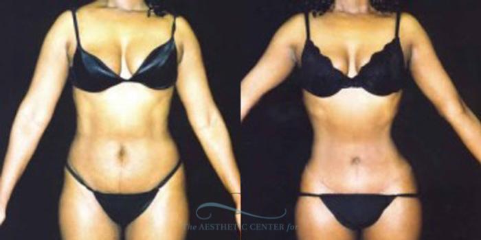 Before & After Liposuction Case 247 Front View: View in Houston, TX