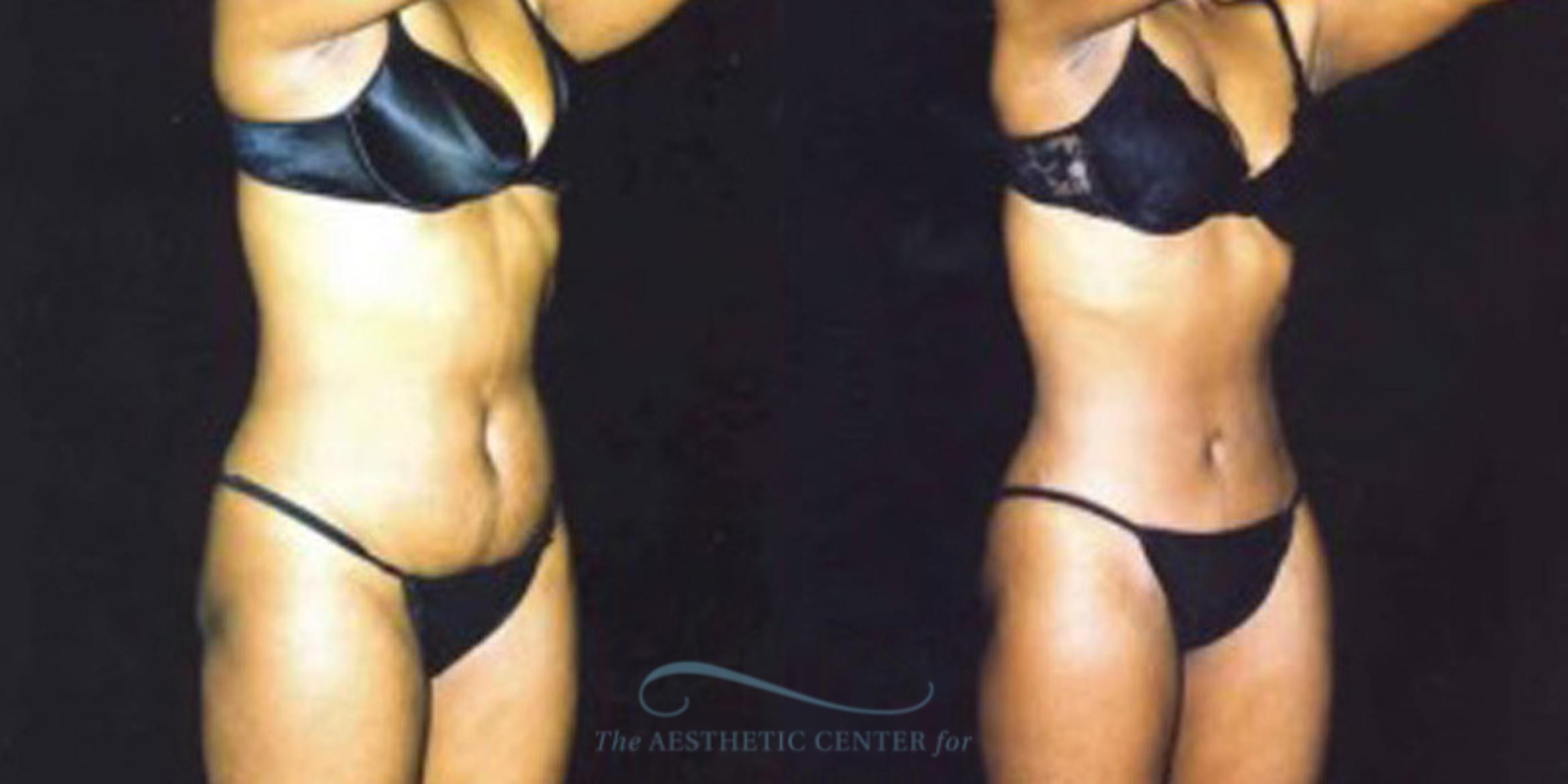 Before & After Liposuction Case 247 Oblique View: View in Houston, TX