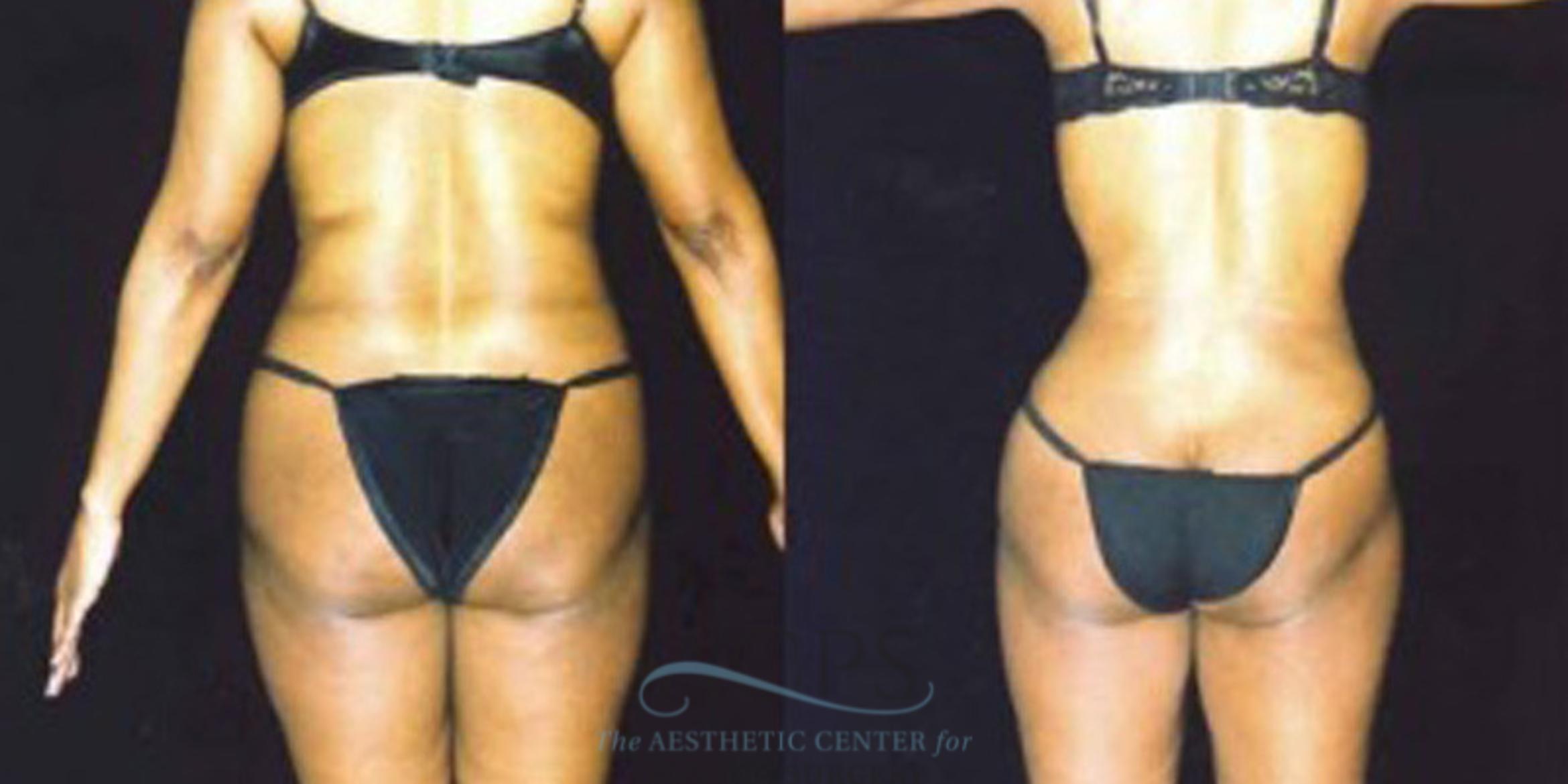 Before & After Liposuction Case 247 Rear View: View in Houston, TX