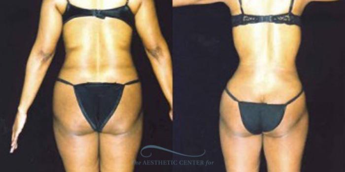 Before & After Liposuction Case 247 Rear View: View in Houston, TX