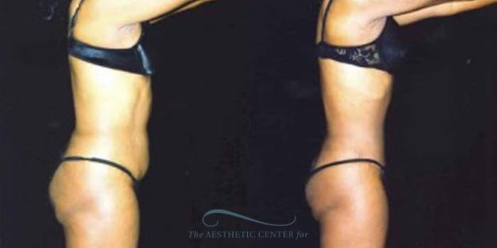 Before & After Liposuction Case 247 Side View: View in Houston, TX