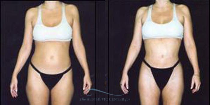 Before & After Liposuction Case 248 Front View: View in Houston, TX