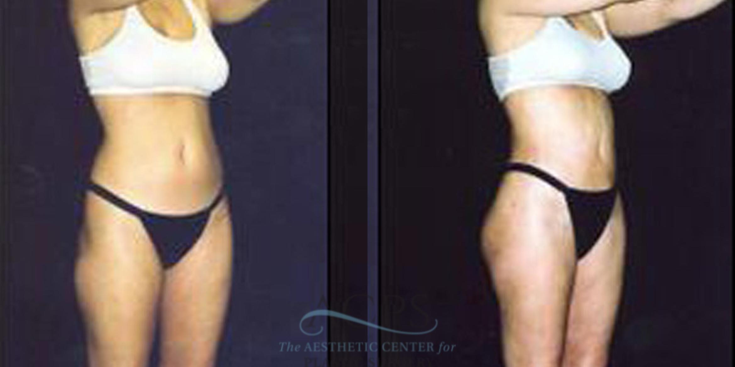 Before & After Liposuction Case 248 Oblique View: View in Houston, TX