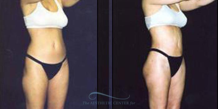 Before & After Liposuction Case 248 Oblique View: View in Houston, TX