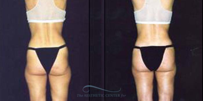 Before & After Liposuction Case 248 Rear View: View in Houston, TX