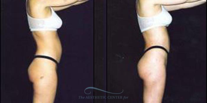 Before & After Liposuction Case 248 Side View: View in Houston, TX