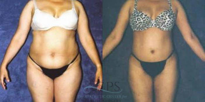 Before & After Liposuction Case 249 Front View: View in Houston, TX