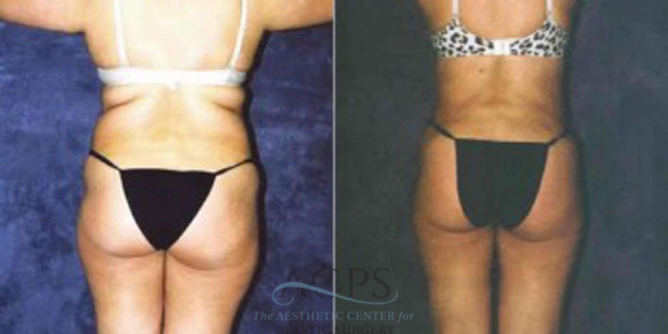 Before & After Liposuction Case 249 Rear View: View in Houston, TX