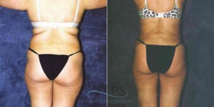 Before & After Liposuction Case 249 Rear View: View in Houston, TX