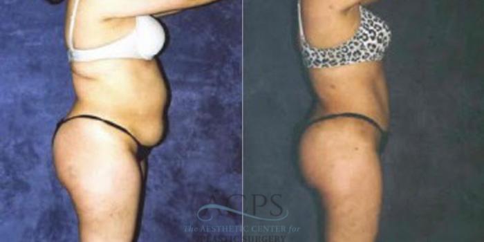 Before & After Liposuction Case 249 Side View: View in Houston, TX