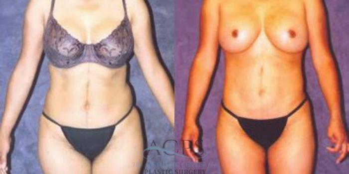 Before & After Breast Augmentation Case 250 Front View: View in Houston, TX