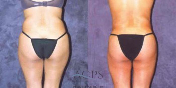 Before & After Breast Augmentation Case 250 Rear View: View in Houston, TX