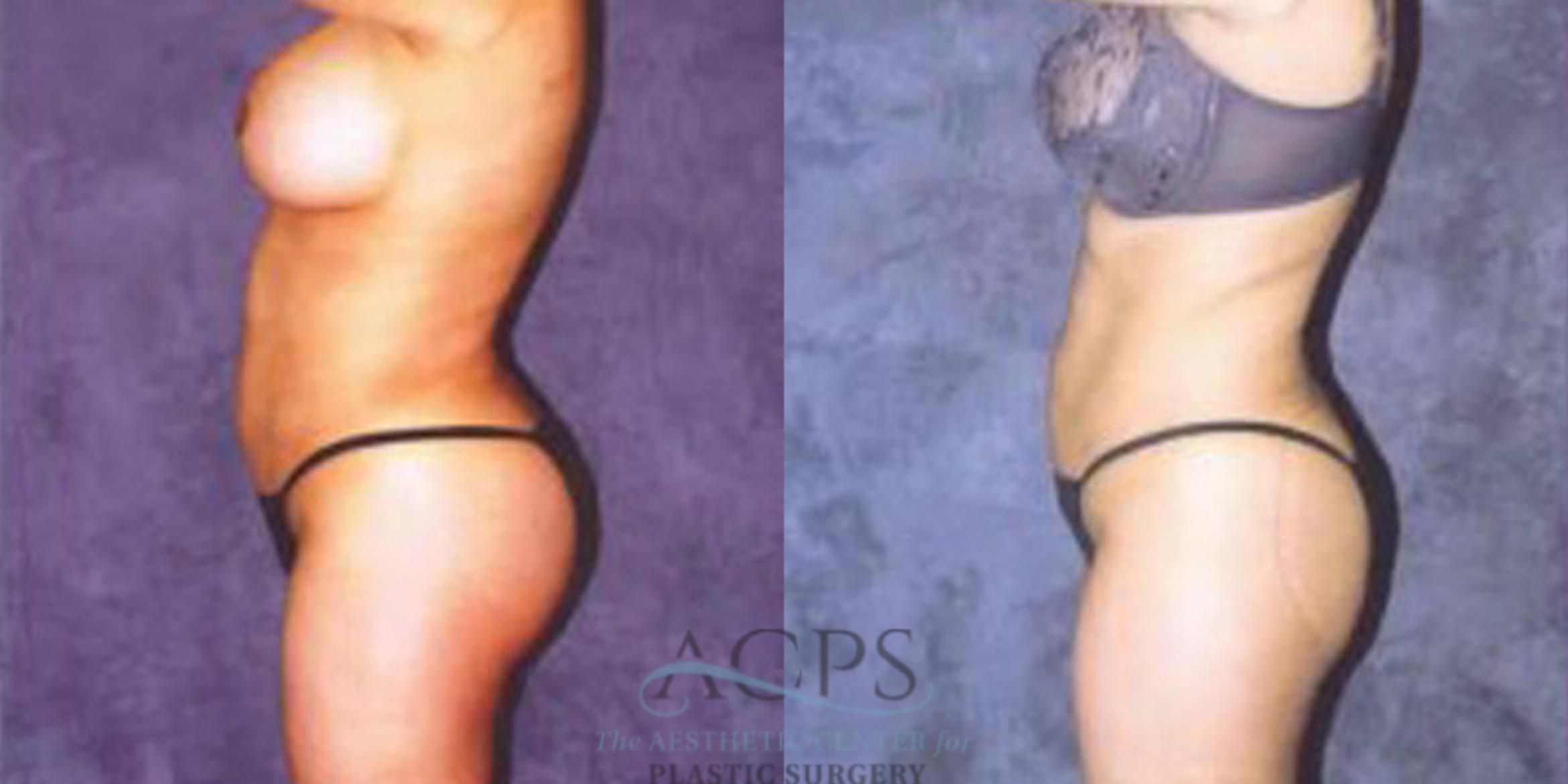 Before & After Breast Augmentation Case 250 Side Left View: View in Houston, TX