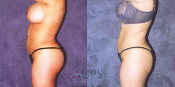 Before & After Breast Augmentation Case 250 Side Left View: View in Houston, TX