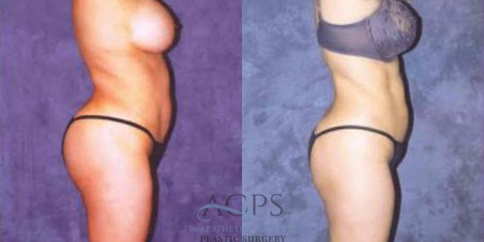 Before & After Breast Augmentation Case 250 Side View: View in Houston, TX