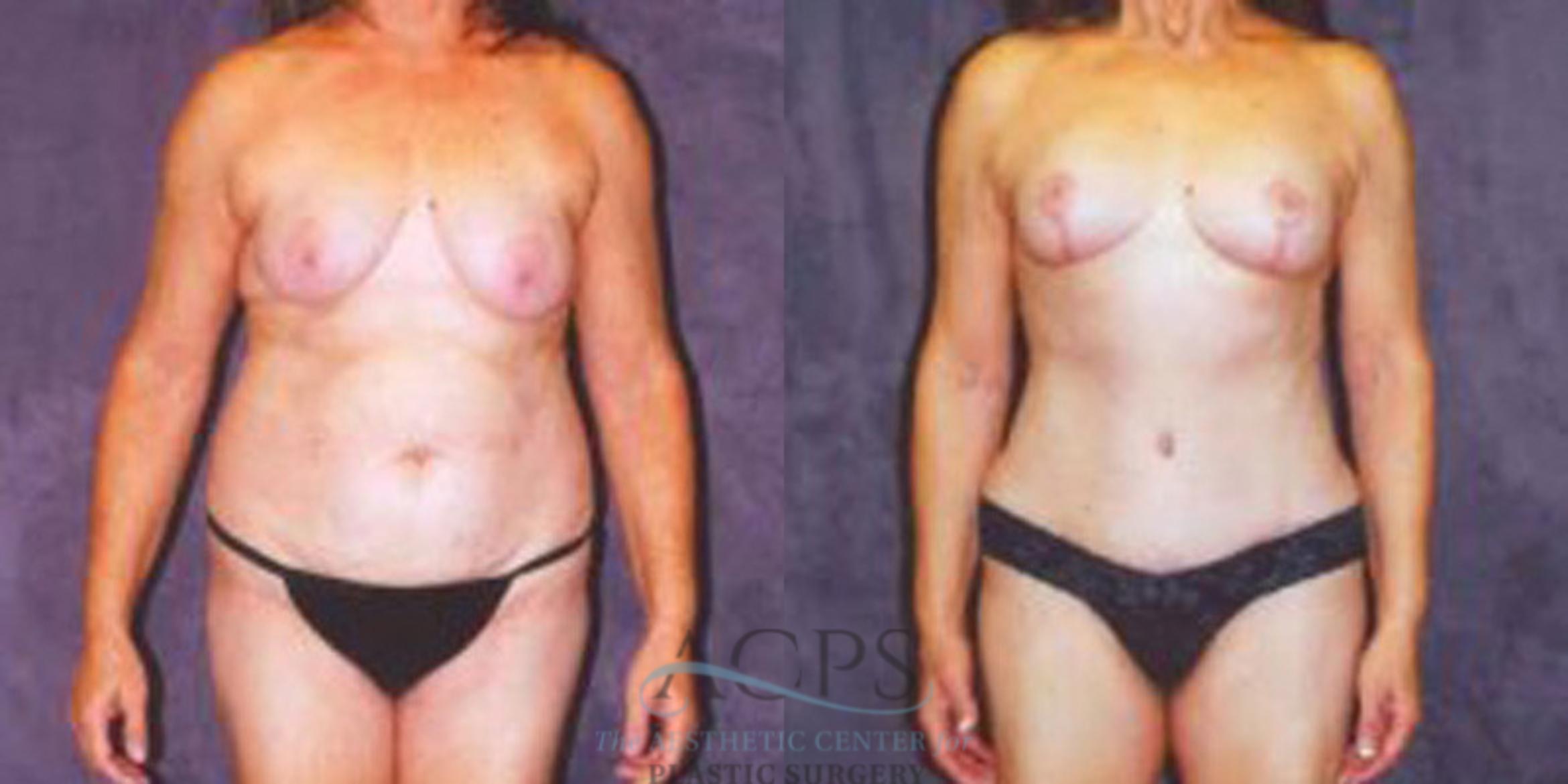 Before & After Breast Augmentation Case 251 Front View: View in Houston, TX