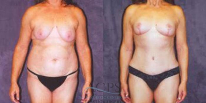 Before & After Breast Augmentation Case 251 Front View: View in Houston, TX