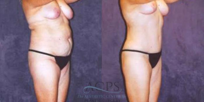 Before & After Breast Augmentation Case 251 Oblique View: View in Houston, TX