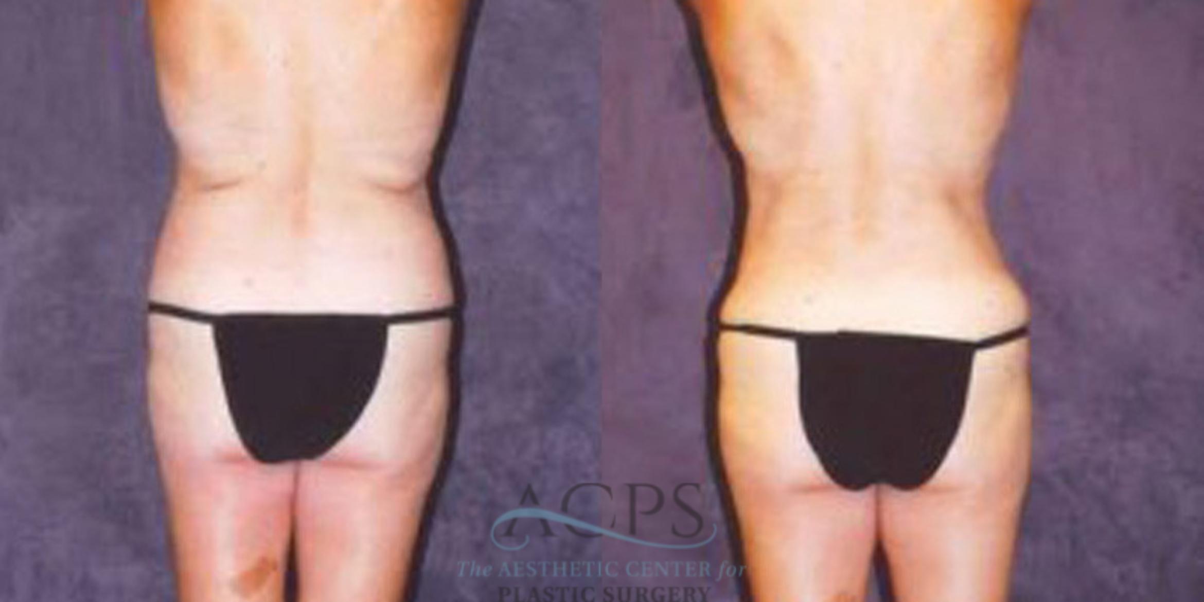 Before & After Breast Augmentation Case 251 Rear View: View in Houston, TX