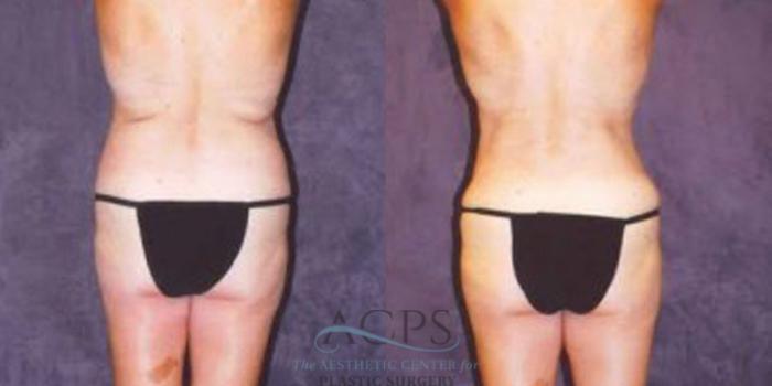 Before & After Breast Augmentation Case 251 Rear View: View in Houston, TX