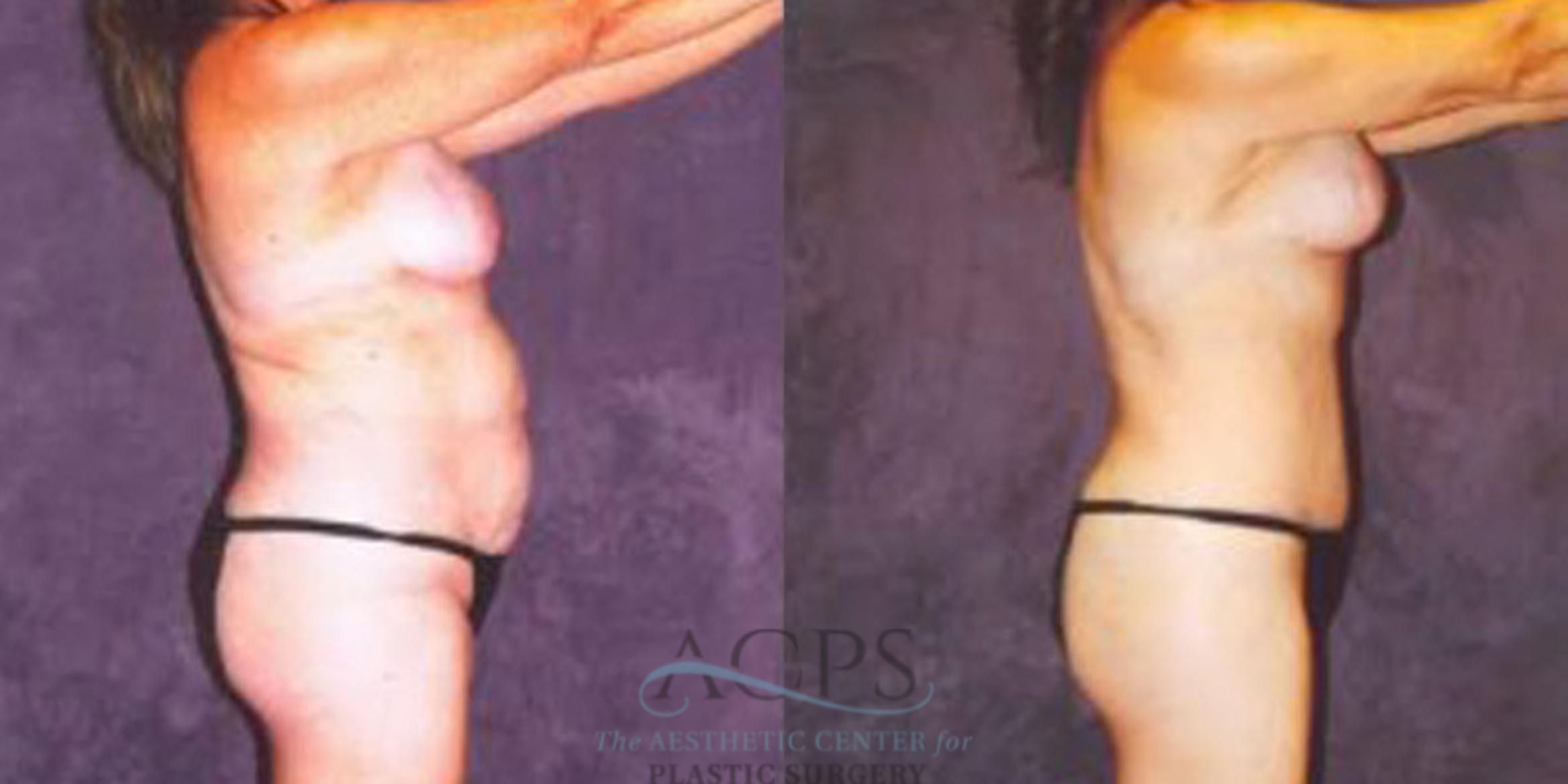 Before & After Breast Augmentation Case 251 Side View: View in Houston, TX