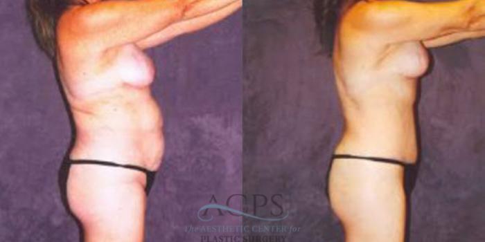 Before & After Breast Augmentation Case 251 Side View: View in Houston, TX