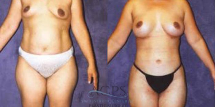 Before & After Liposuction Case 252 Front View: View in Houston, TX