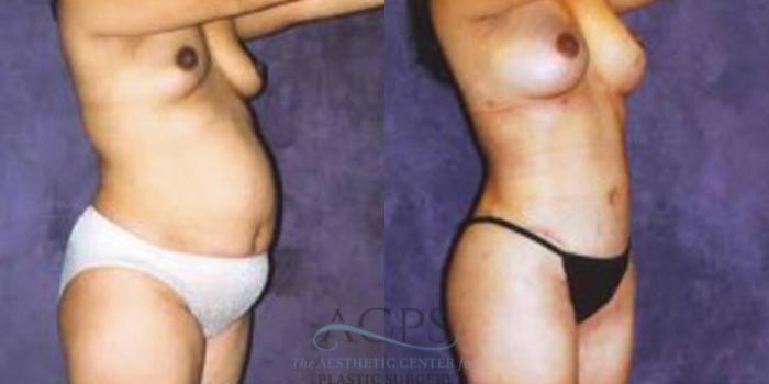Before & After Liposuction Case 252 Oblique View: View in Houston, TX