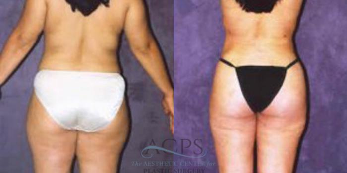 Before & After Liposuction Case 252 Rear View: View in Houston, TX