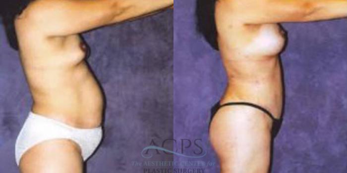 Before & After Liposuction Case 252 Side View: View in Houston, TX
