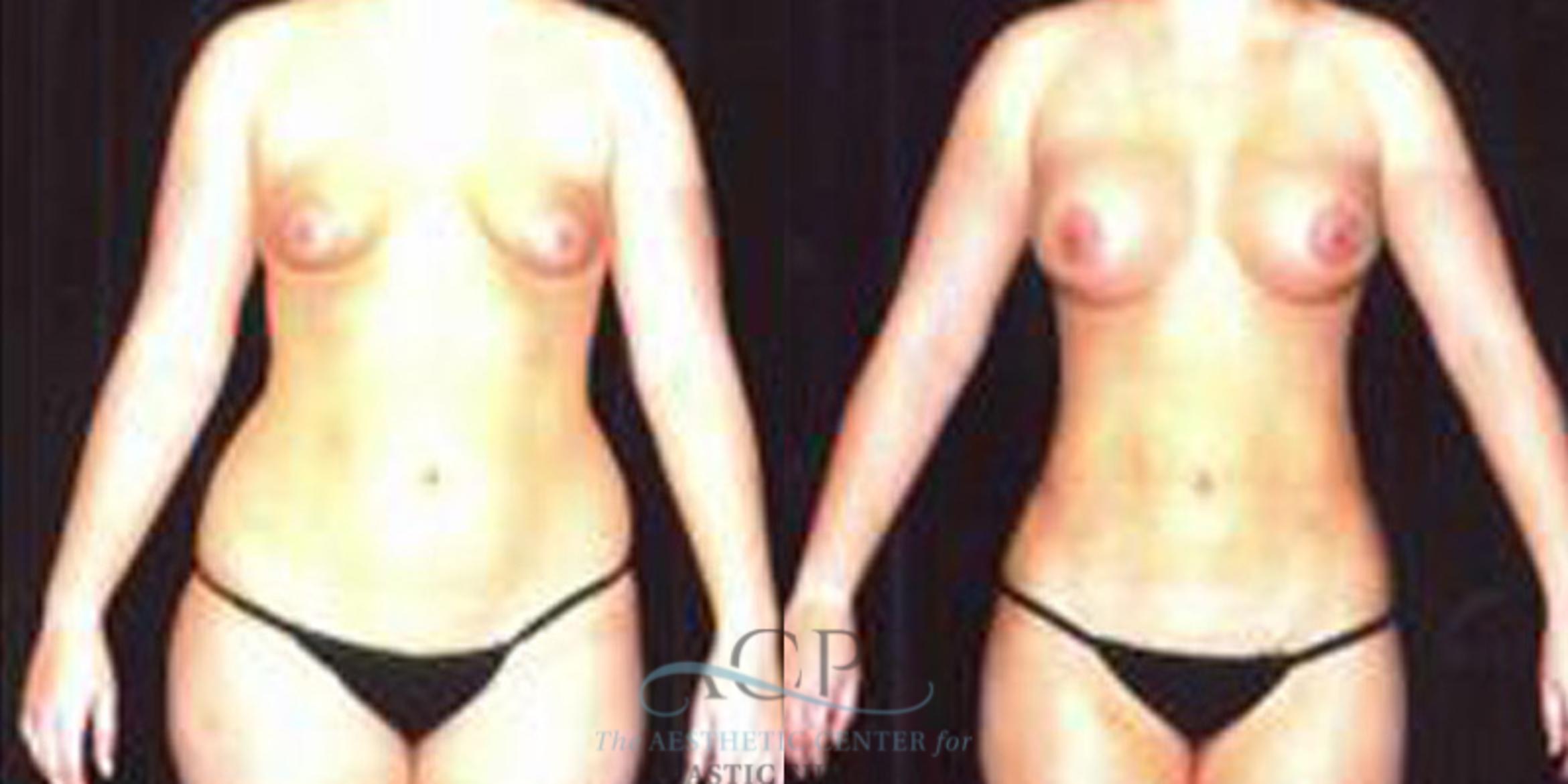 Before & After Liposuction Case 253 Front View: View in Houston, TX