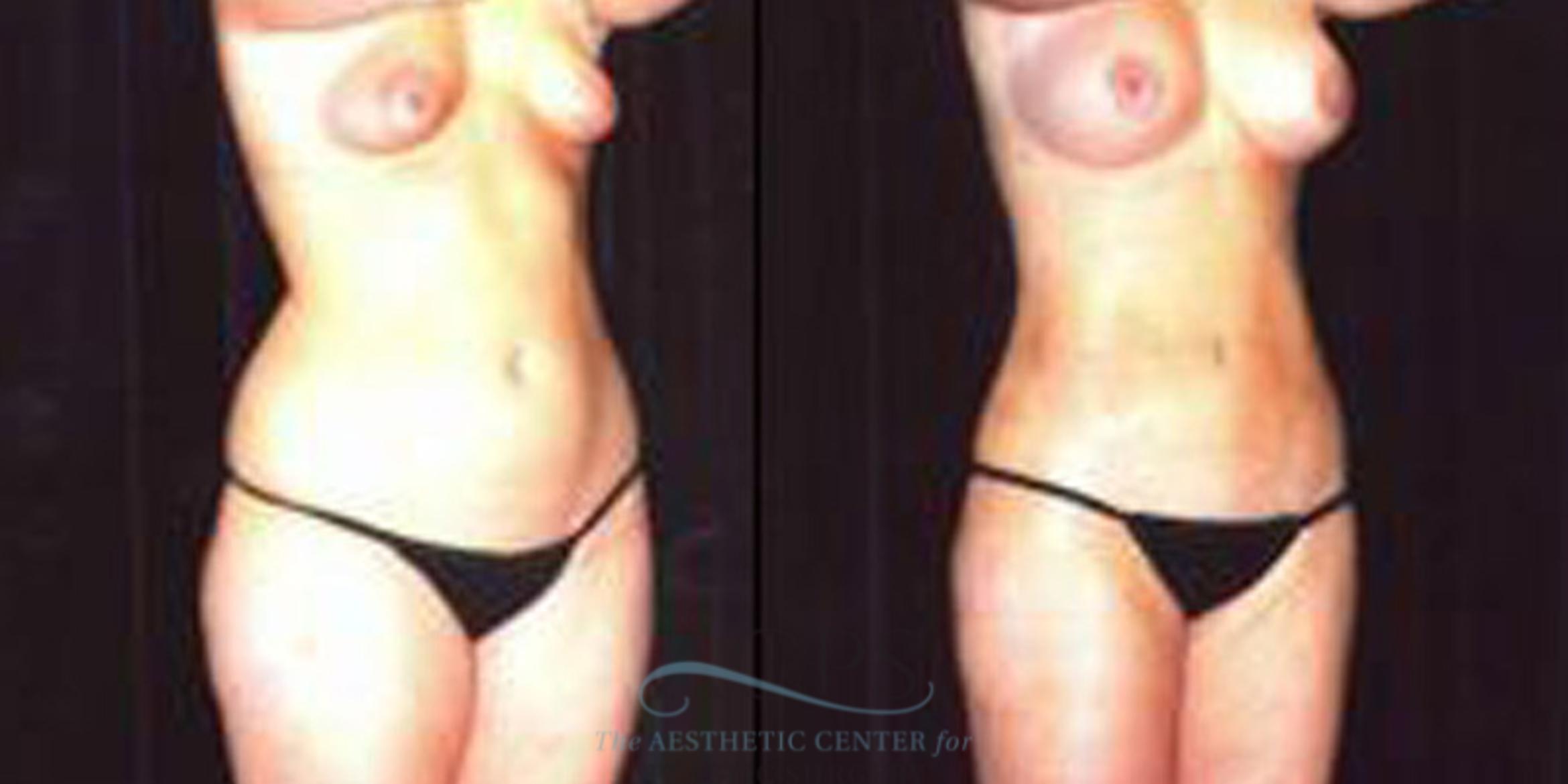 Before & After Liposuction Case 253 Oblique View: View in Houston, TX