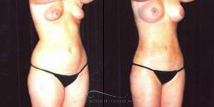 Before & After Liposuction Case 253 Oblique View: View in Houston, TX