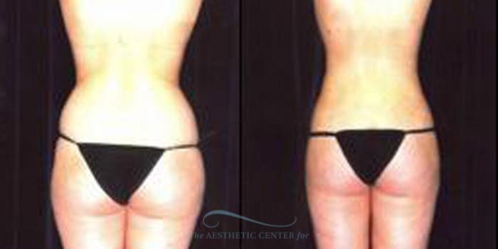 Before & After Liposuction Case 253 Rear View: View in Houston, TX