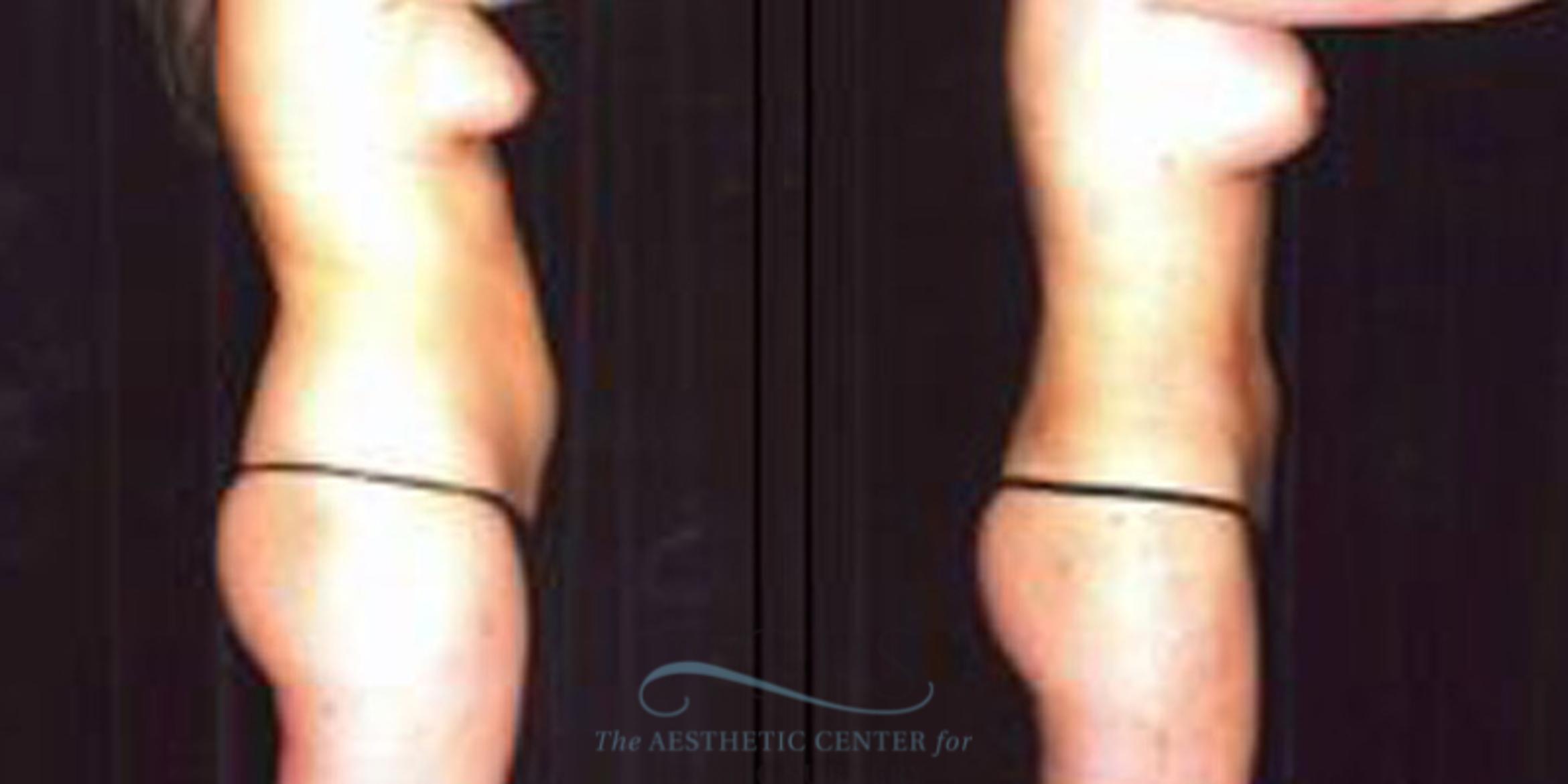 Before & After Liposuction Case 253 Side View: View in Houston, TX