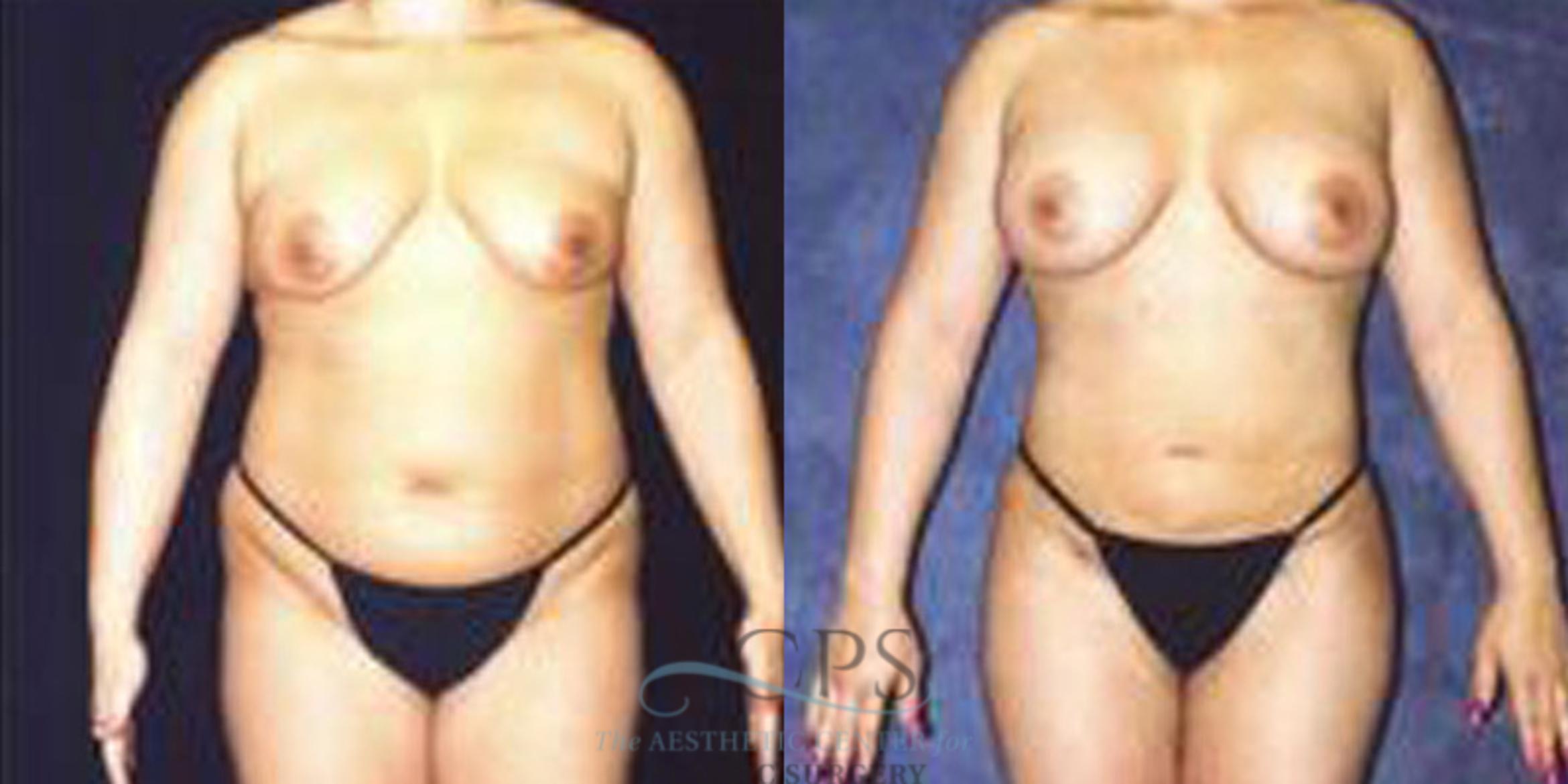 Before & After Breast Augmentation Case 254 Front View: View in Houston, TX
