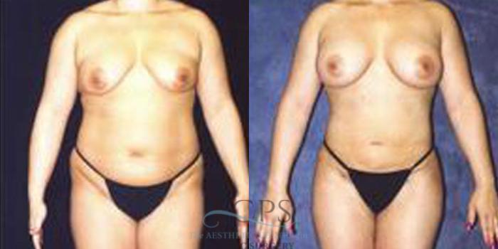 Before & After Breast Augmentation Case 254 Front View: View in Houston, TX