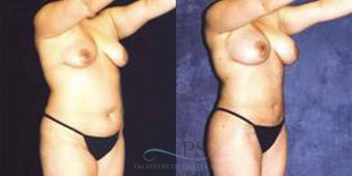 Before & After Breast Augmentation Case 254 Oblique View: View in Houston, TX